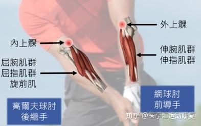 高尔夫球肘的治疗方法
