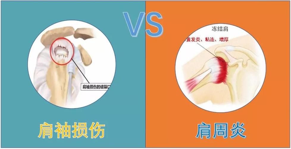 肩周炎与乒乓球运动
