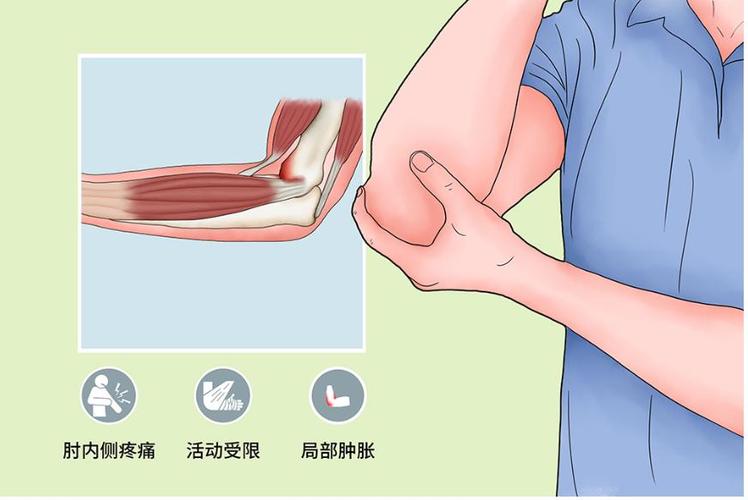 高尔夫球肘的症状