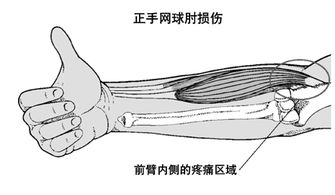 网球肘与高尔夫球肘