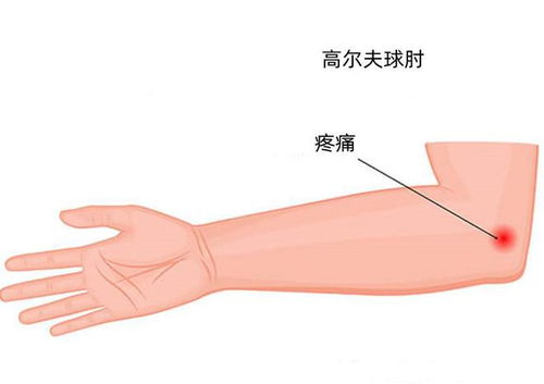 高尔夫球肘疼痛位置