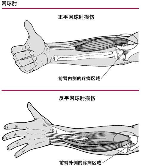 高尔夫球肘的最新治疗方法