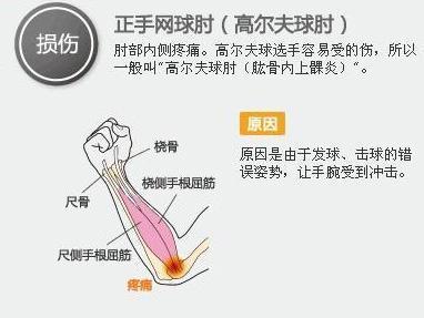 高尔夫肘治疗方法