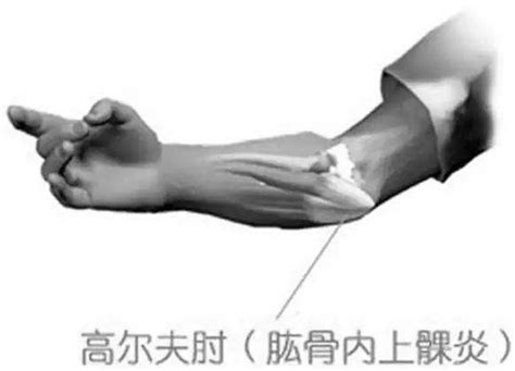 高尔夫球肘怎么能治愈