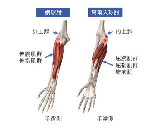 高尔夫球肘肿吗
