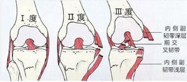 打乒乓球会膝盖疼吗