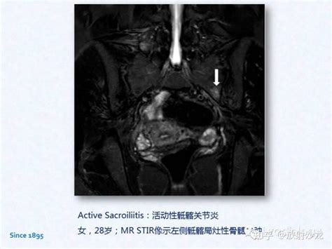 高尔夫球肘炎能根治吗